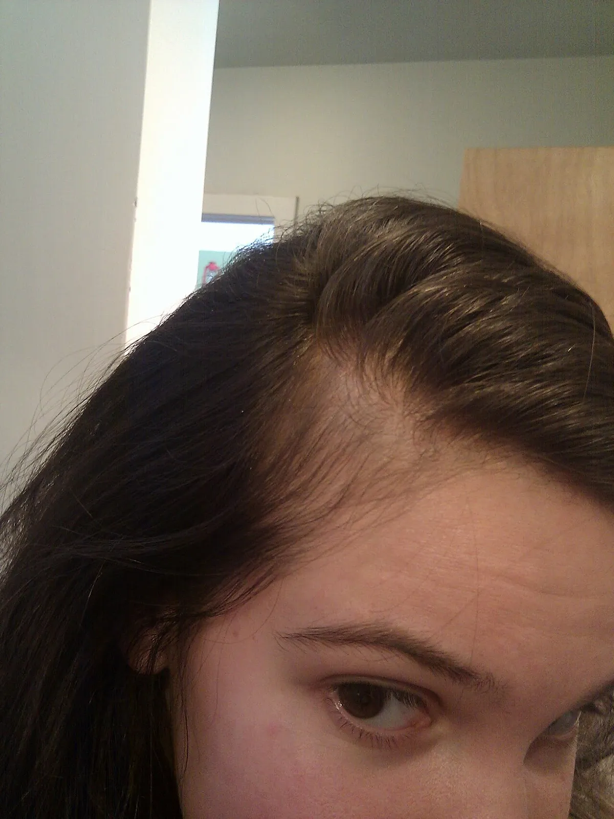 Cheveux clairsemés à la tempe d'une jeune femme quelques mois après l'accouchement