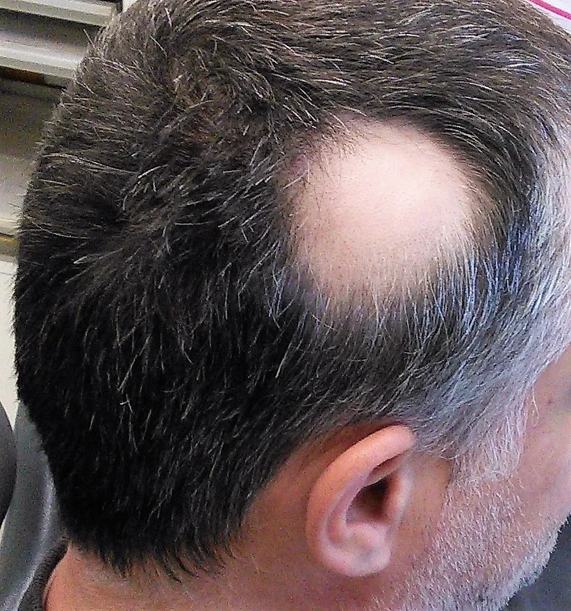 Chiazza calva rotonda sulla nuca di un uomo con alopecia areata