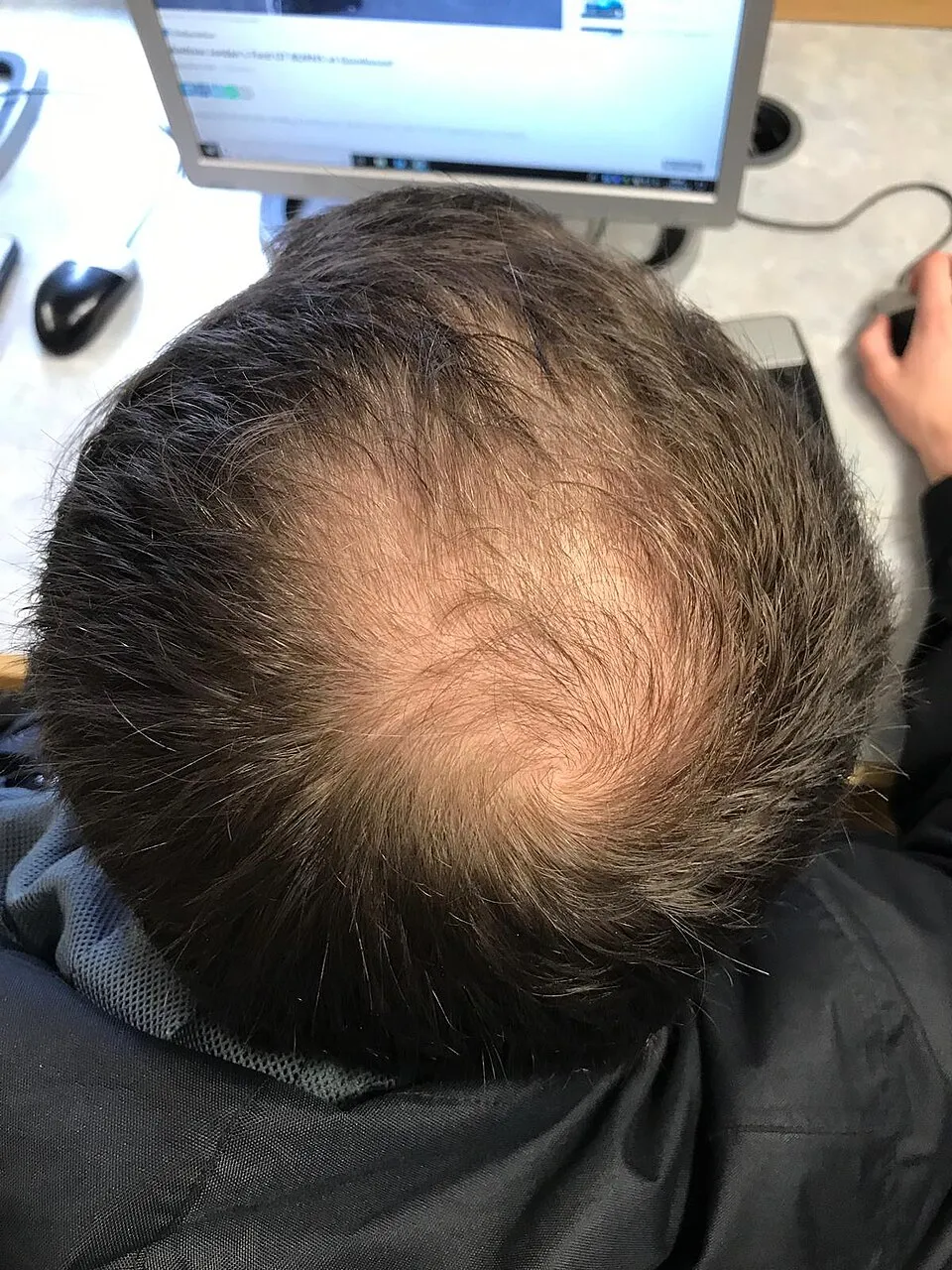 Vue du dessus de l'arrière de la tête d'un homme avec une tonsure qui s'éclaircit au niveau de l'épi