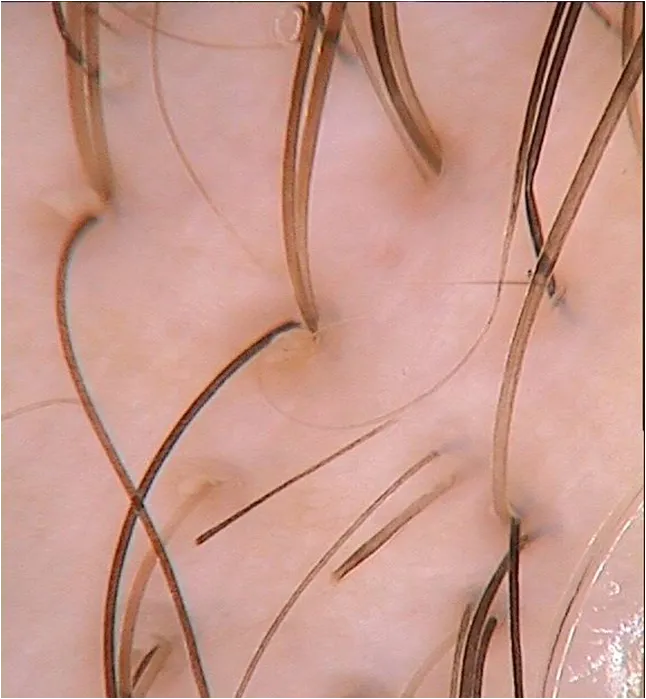 Immagine ingrandita del cuoio capelluto con fusti dei capelli e aperture follicolari